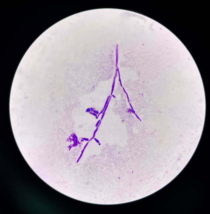 Budding Yeast Cells with Pseudohyphae in Urine Sample on Wright Gimsa