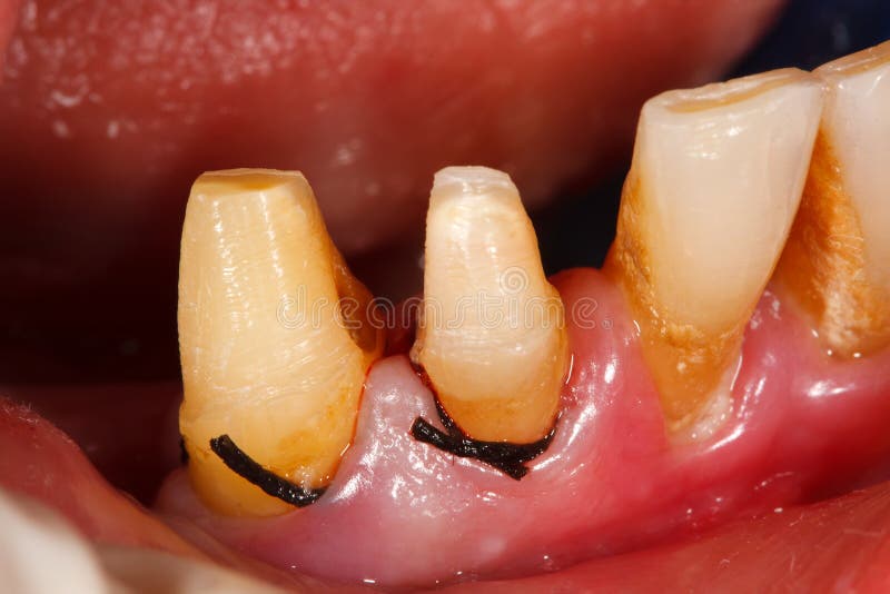 Dental Cord Placing In Gingival Sulcus Stock Photo Image of dentist