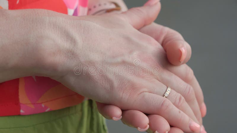 Bulging Veins on Women`s Arms Stock Photo - Image of medical, disease