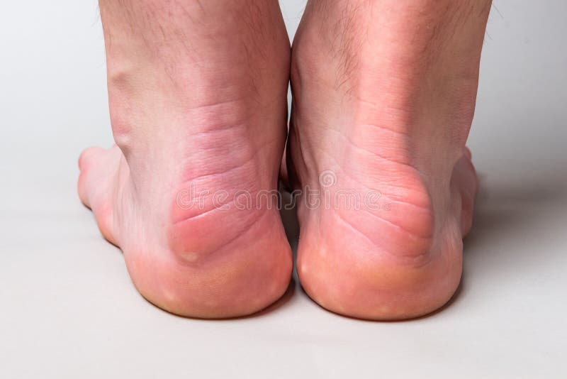 Bump on the Back of Heel Bone Called Haglund`s Deformity on Gray