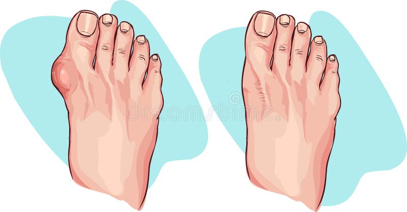 Bunion before and after operation. Vector illustration.