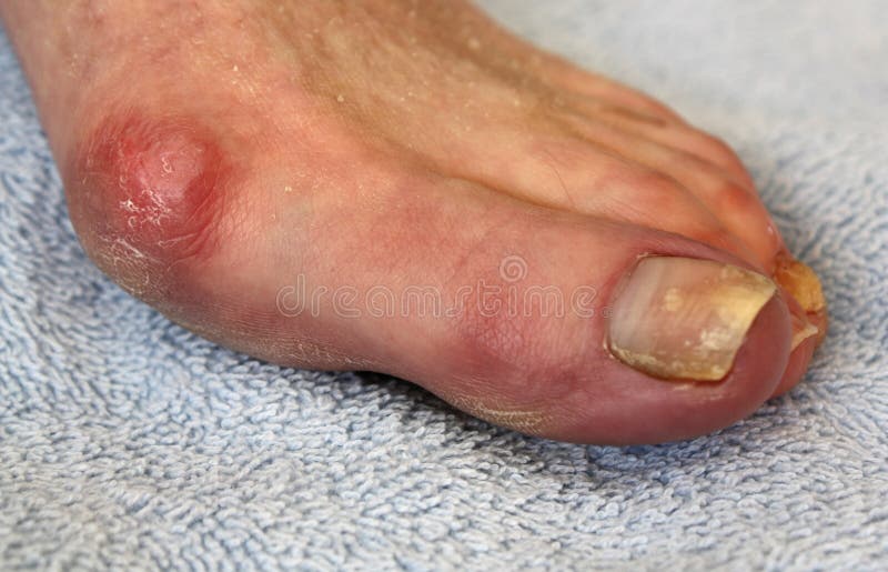 Bunion und Zehennagel-Pilz lizenzfreie stockfotografie Bunion und Zehennagel-Pilz lizenzfreie stockfotografie