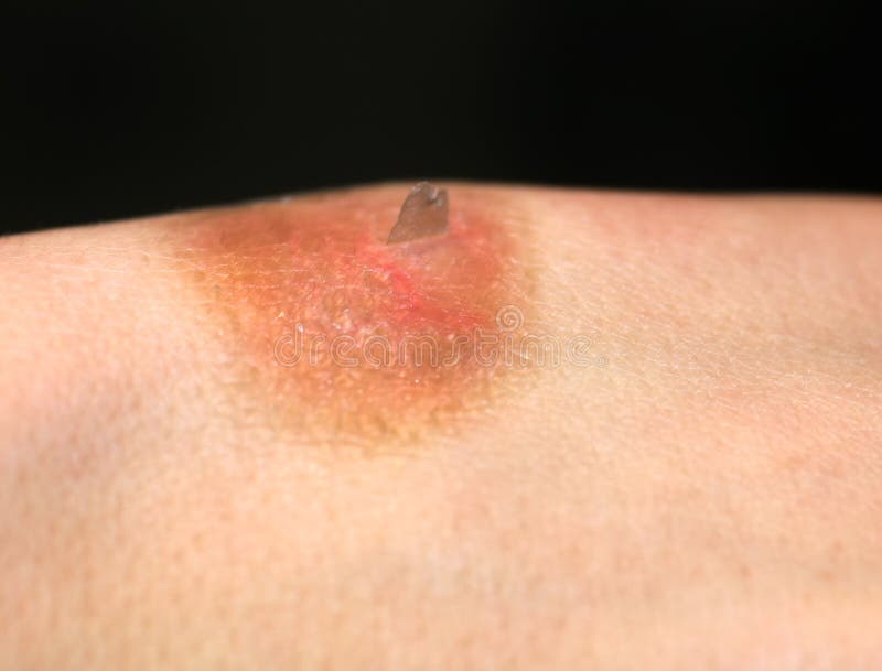 Brown spot on skin after burn. 