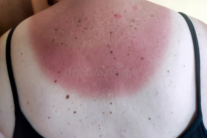 Burned Skin on the Back. Incorrect Tanning of the Body Stock Image