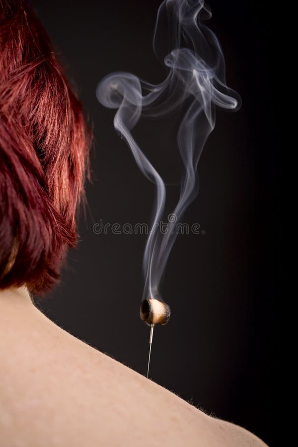 Burning Moxa on Acupuncture Needle Stock Photo Image of moxa, neck