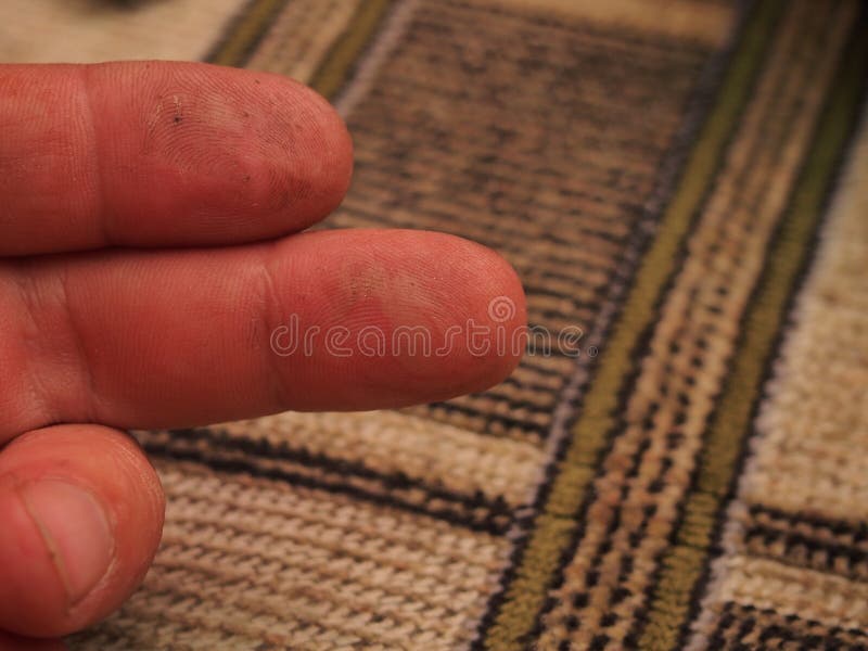 Burns on the Skin of Fingers. Bubbles on the Skin Stock Photo Image