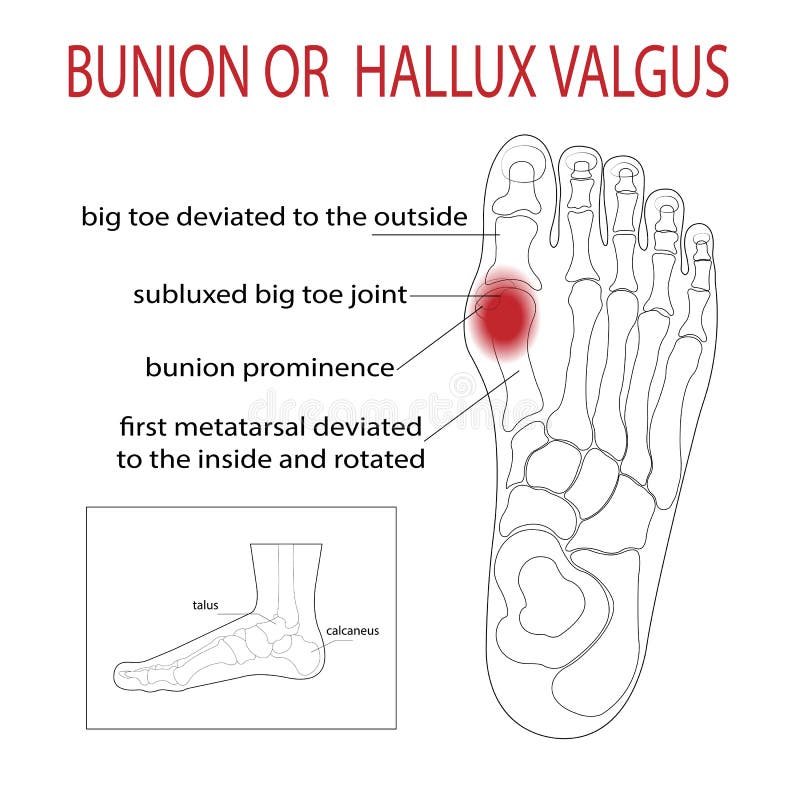 The Bone and Skin on the Sides of the Big Toe Joint Form an Abnormal