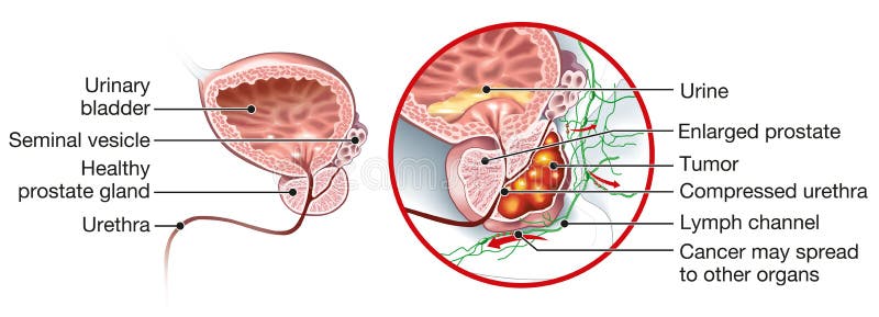 Cancerul de prostata: Simptome, Cauze, Tratament - climbcenter.ro