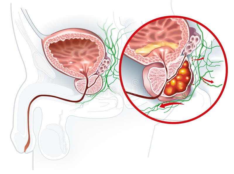 Cancerul de prostata: Simptome, Cauze, Tratament - Doc.ro
