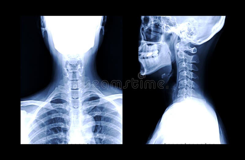 X-ray C-spine or x-ray image of Cervical spine AP and Lateral view for diagnostic intervertebral disc herniation