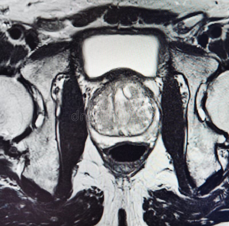 Ca prostate mri exam diagnostic