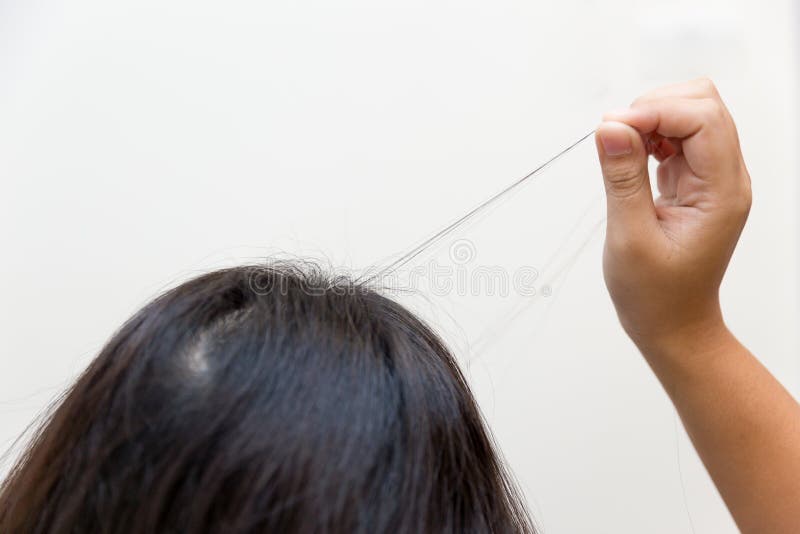 Cabelo que puxa a desordem ou o Trichotillomania na saúde mental das mulheres do adolescente foto de stock royalty free Cabelo que puxa a desordem ou o Trichotillomania na saúde mental das mulheres do adolescente foto de stock royalty free