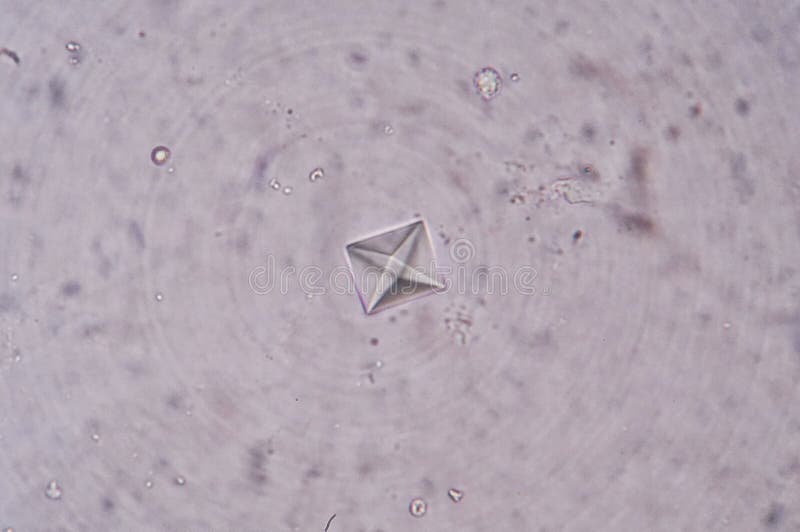 Cristalli Di Ossalato Di Calcio Nelle Urine Calcium Oxalate Crystals In Synovial Fluid