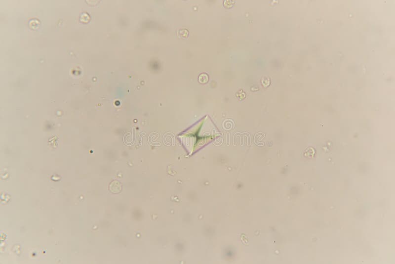 Urine Crystals, Red Blood Cells and Leukocytes at the Microscope