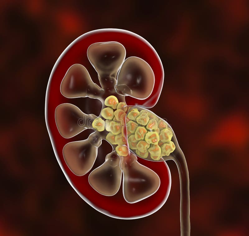 Calculs rénaux, nephrolithiasis illustration de vecteur Calculs rénaux, nephrolithiasis illustration de vecteur