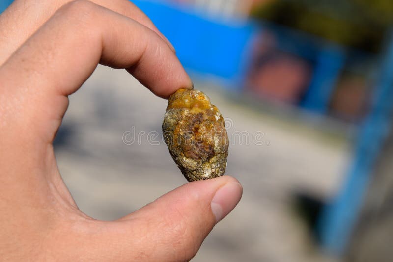 Piedra de vesícula biliar.