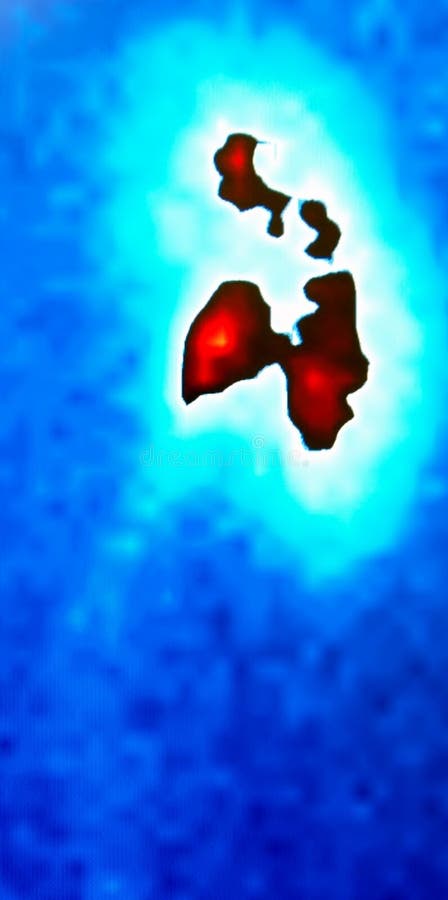 Renal flow nuclear scan , unique example of function in real exam all structures of kidney,there are in red and brown colors upper, middle and lower calyxes and pelvis,impressive for urologist image. Renal flow nuclear scan , unique example of function in real exam all structures of kidney,there are in red and brown colors upper, middle and lower calyxes and pelvis,impressive for urologist image