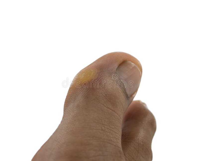 Calo no dedo do pé foto de stock. Imagem de toes, miúdo - 102166820