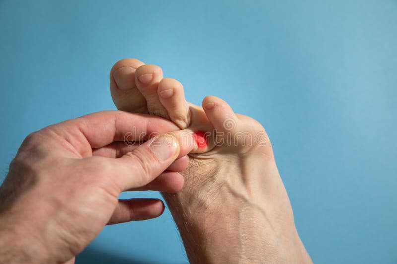 Callus on the Foot. Skin Problems Stock Photo Image of barefoot