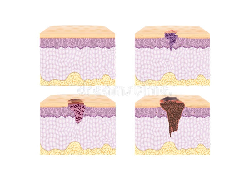 Camada de espalhamento normal da pele e de célula cancerosa no estilo do vetor ilustração royalty free Camada de espalhamento normal da pele e de célula cancerosa no estilo do vetor ilustração royalty free