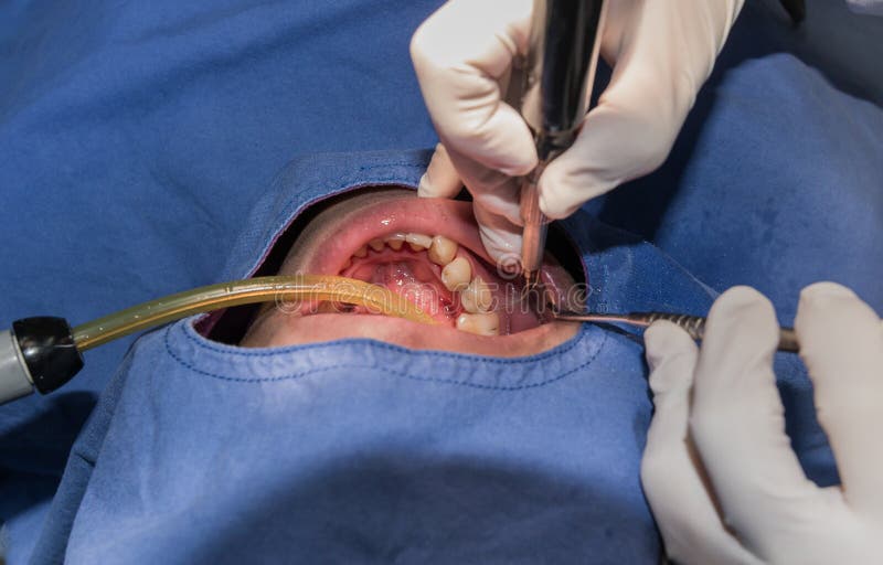 Canal radiculaire ou équipements de chirurgie et chirurgicaux endodontic photo libre de droits Canal radiculaire ou équipements de chirurgie et chirurgicaux endodontic photo libre de droits