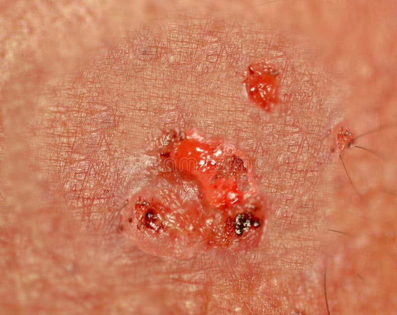Cancer of skin royalty free stock image Cancer of skin royalty free stock image