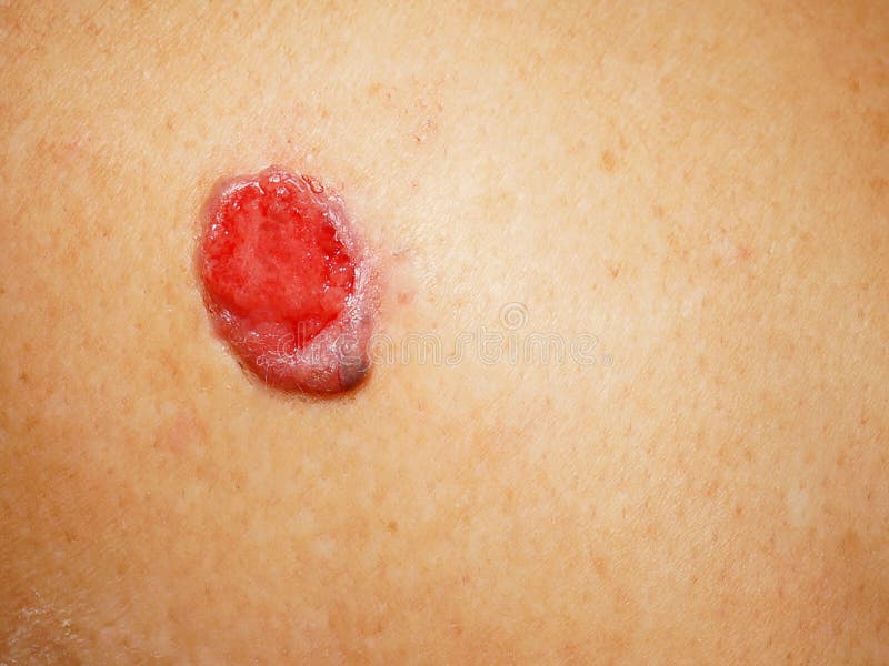 Cancer of skin, ulcerated lesion is close-up.
