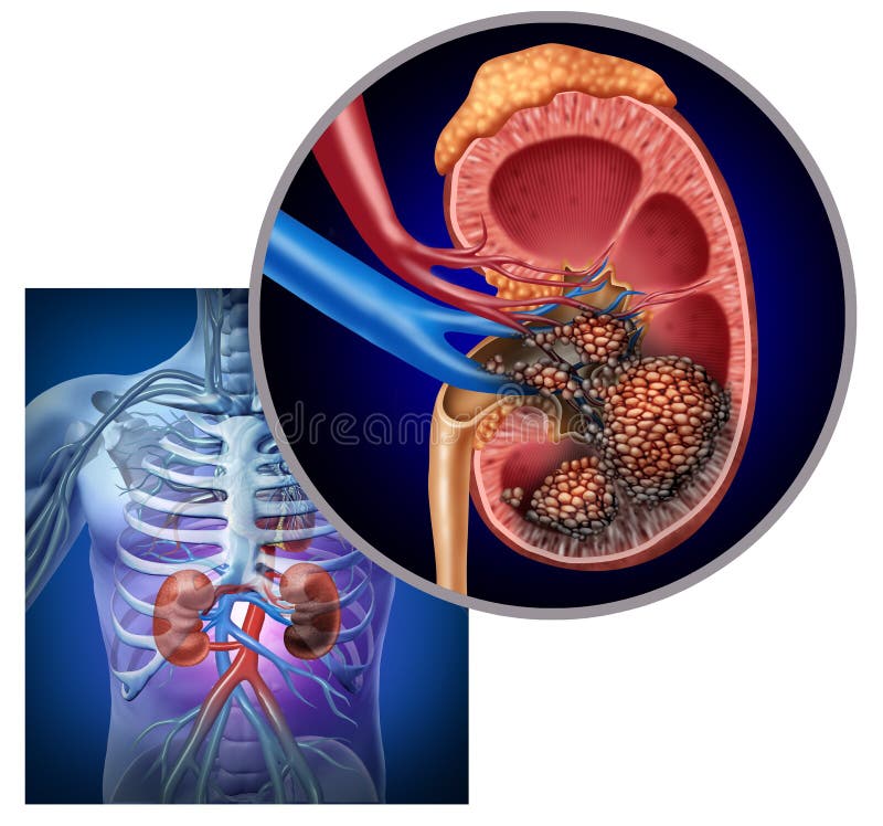 Cancro Dei Reni royalty illustrazione gratis Cancro Dei Reni royalty illustrazione gratis