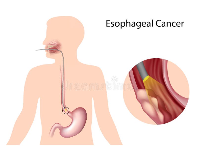 Cancro esofageo royalty illustrazione gratis Cancro esofageo royalty illustrazione gratis