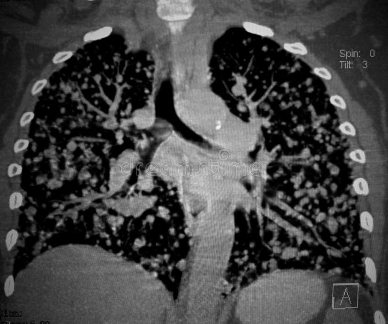Cancro, metastasi dei polmoni Ricostruzione di ricerca di CT