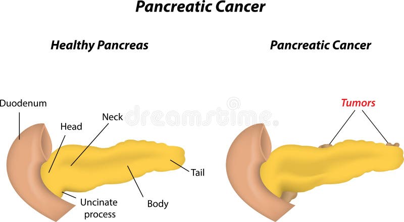 Cancro pancreatico illustrazione vettoriale Cancro pancreatico illustrazione vettoriale