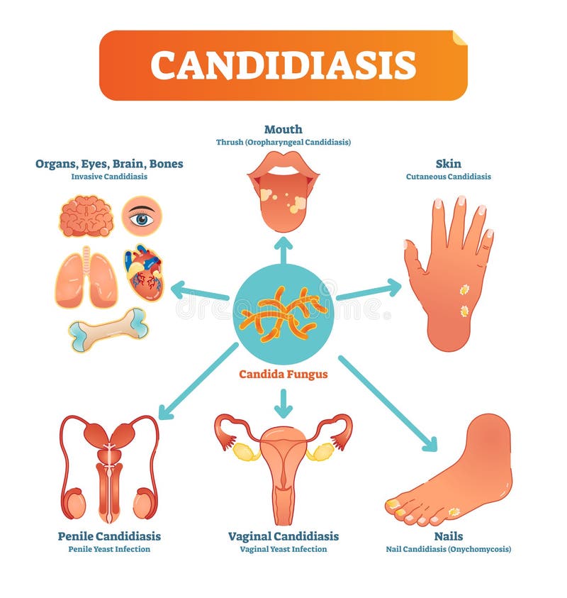 Fungal Infections - Causes, Symptoms, Diagnosis, Treatment & Prevention