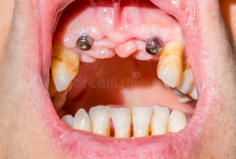 Canine Dental Implants in the Mouth of a Patient with Advanced P Stock