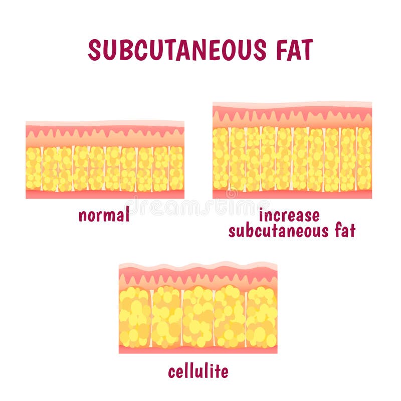 Leather sectional layer of subcutaneous fat, cellulite scheme. Leather sectional layer of subcutaneous fat, cellulite scheme