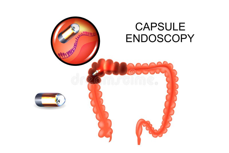 Vector illustration of capsule endoscopy of the colon