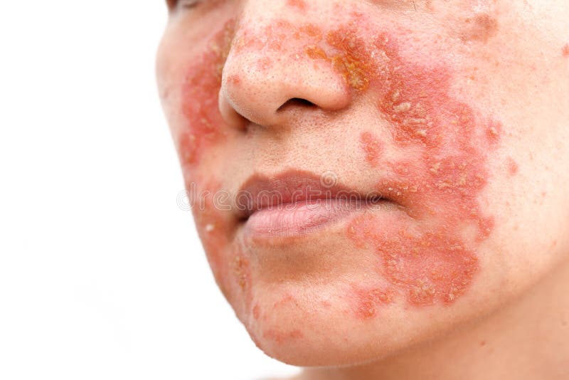 Cara Del Dermatitis Foto de archivo - Imagen rojo, eczema: 111929664