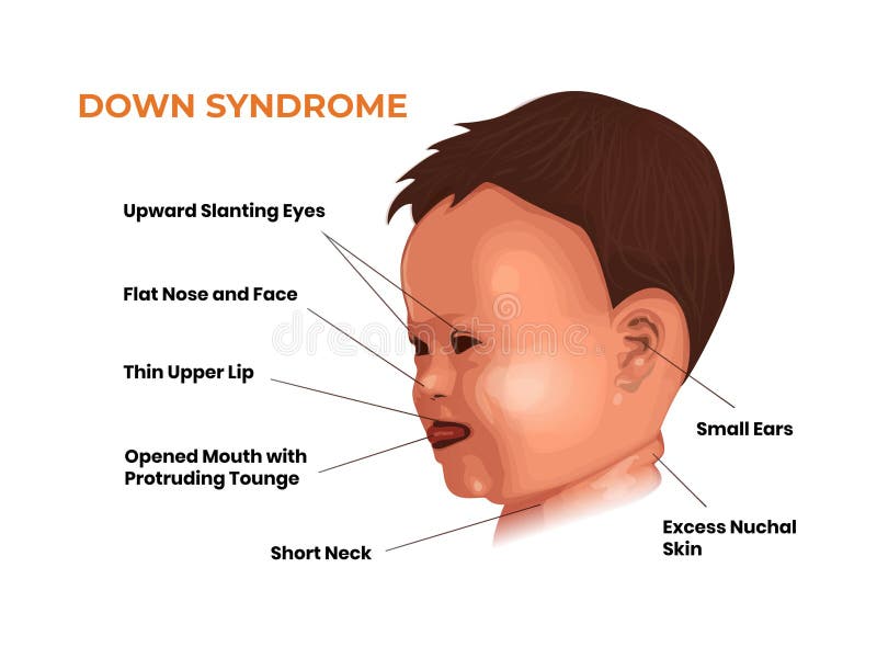 Características faciales del bebé con síndrome de down. trisomía 21 síntomas
