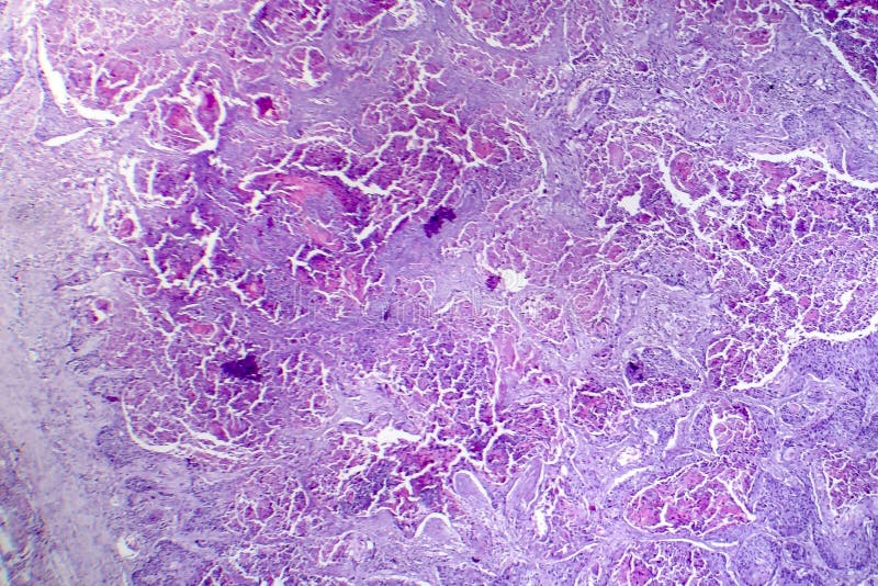 Carcinoma de células escamosas del pulmón imágenes de archivo libres de regalías Carcinoma de células escamosas del pulmón imágenes de archivo libres de regalías