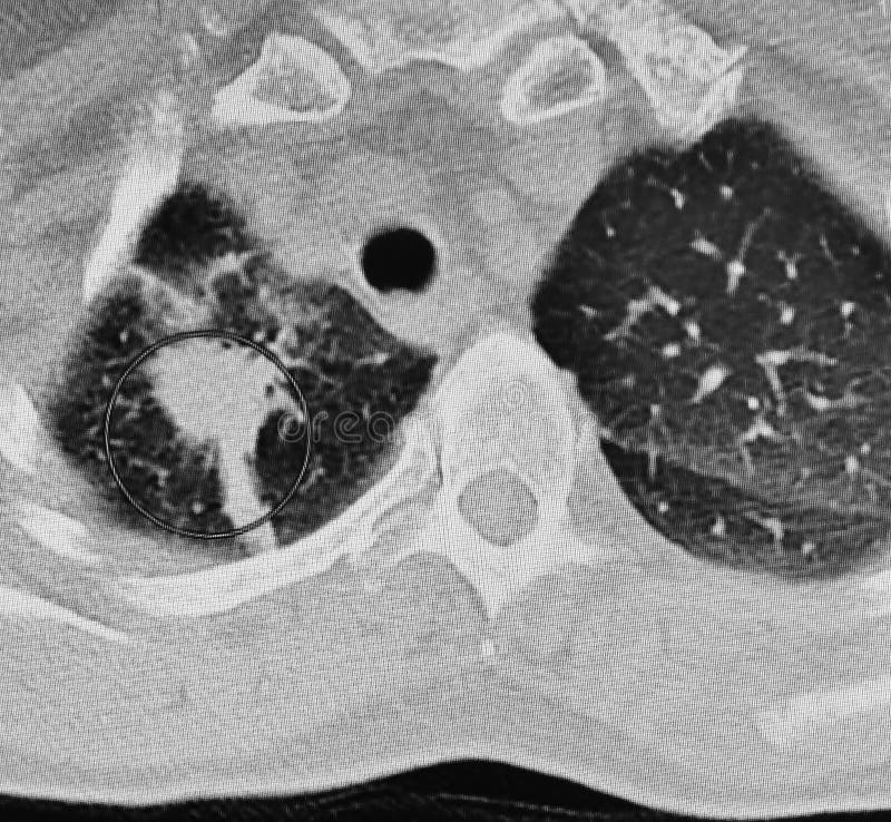 There is CT scan, about 7 cm right lung lower lobe mass with adjacent satellite nodules concerning for primary lung neoplasm , white spot in the left part of image marked by circle. There is CT scan, about 7 cm right lung lower lobe mass with adjacent satellite nodules concerning for primary lung neoplasm , white spot in the left part of image marked by circle.