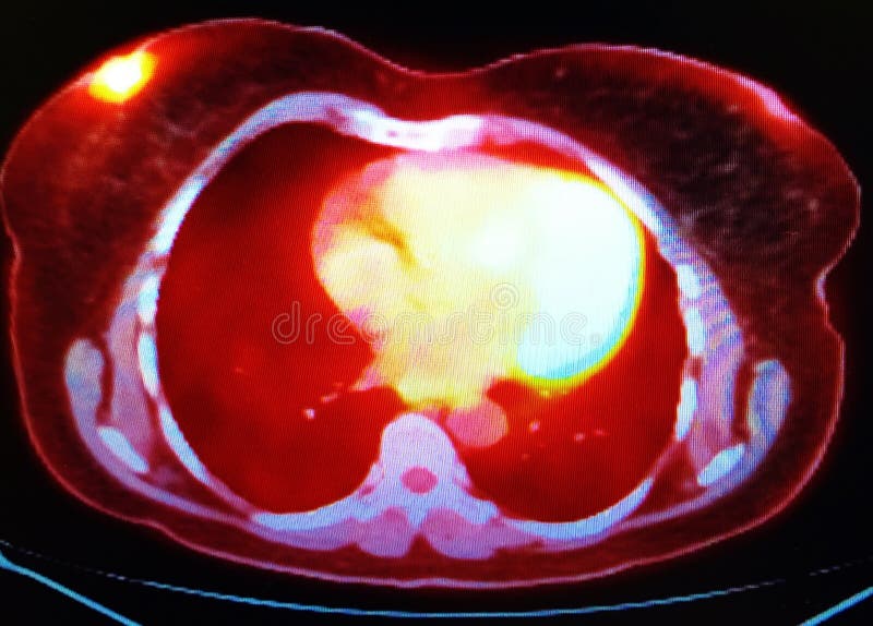 PET/CT tomography scan revealed breast oncological pathology as periareolar primary carcinoma. Yellow spot in the left upper part of image is pathological activity of carcinoma. PET/CT tomography scan revealed breast oncological pathology as periareolar primary carcinoma. Yellow spot in the left upper part of image is pathological activity of carcinoma.