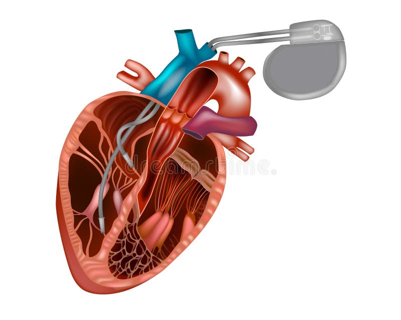 Cardiac Pacemaker Or Artificial Pacemaker Stock Vector Illustration Of Heart Inside 178088152