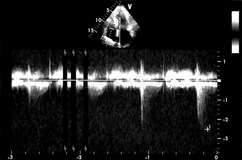 Cardiac Ultrasound Images . Doppler Echo Stock Photo - Image of atrium