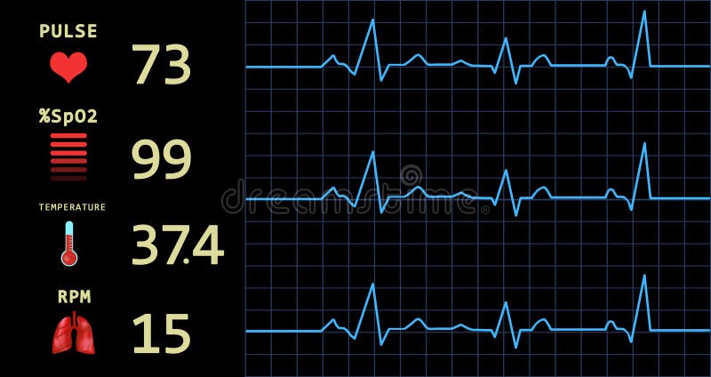 Cardiogram And Data On Display Of Heart Rate Monitor. Illustration Stock  Illustration - Illustration Of Cardiology, Anesthesia: 209519110