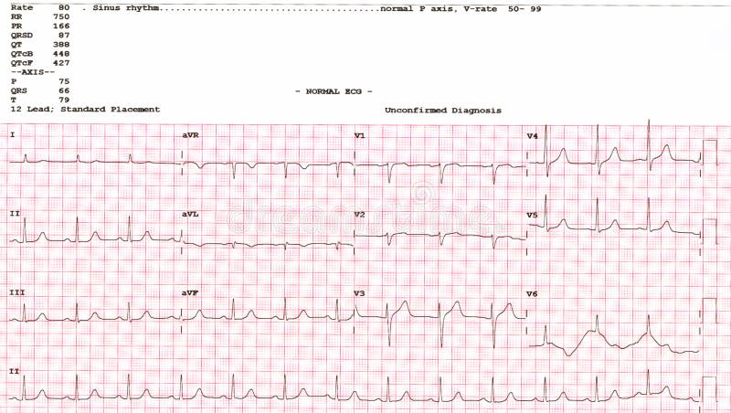 Medical image cardiogram. waveform from an EKG showing normal EKG test,on white background. Medical image cardiogram. waveform from an EKG showing normal EKG test,on white background.