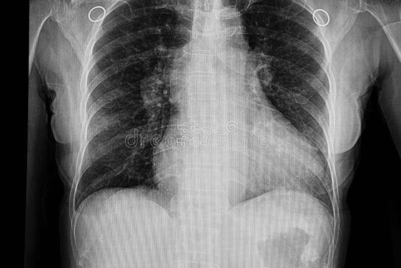 cardiomegaly with congestive heart failure