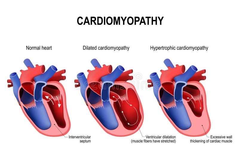 Cardiomiopatía hipertrófica, cardiomiopatía y sano dilatada