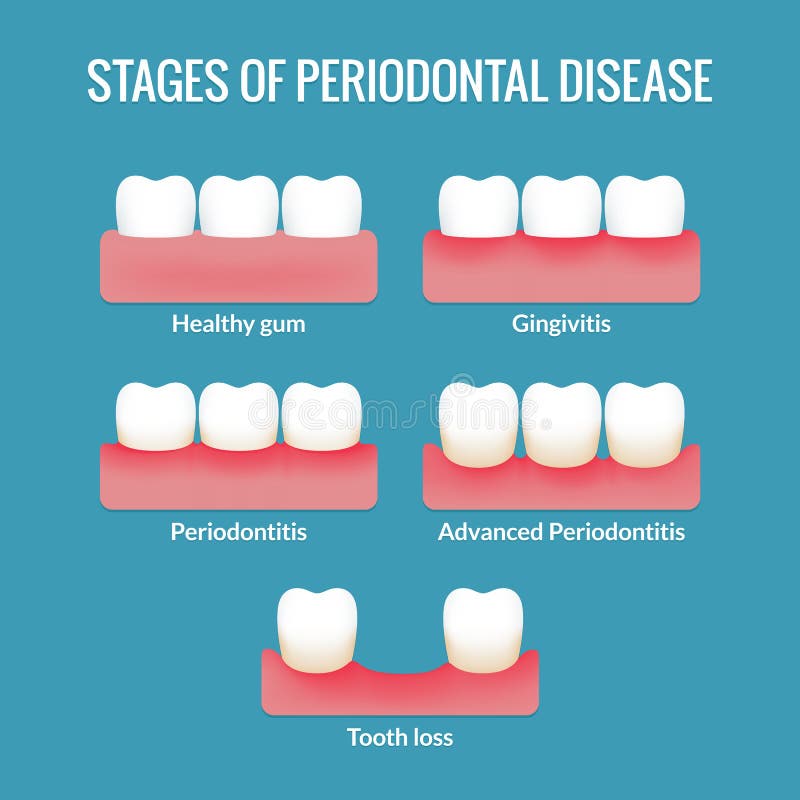 Carta da doença peridental ilustração do vetor Carta da doença peridental ilustração do vetor