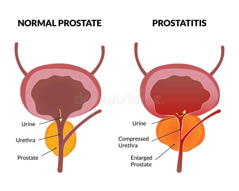  Cartel de la patología de la prostatitis stock de ilustración