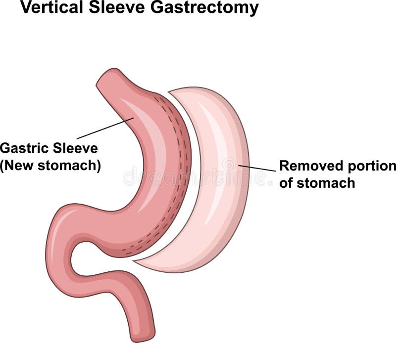 Cartoon illustration of Vertical Sleeve Gastrectomy (VSG) vector illustration Cartoon illustration of Vertical Sleeve Gastrectomy (VSG) vector illustration