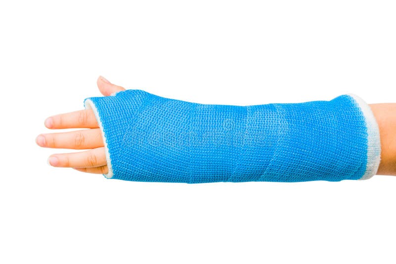 Broken Arm Stock Photo - Download Image Now - Orthopedic Cast, Broken Arm,  Broken - iStock